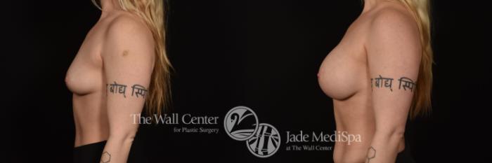 Before & After Breast Augmentation Case 1092 Left Side View in Shreveport, LA