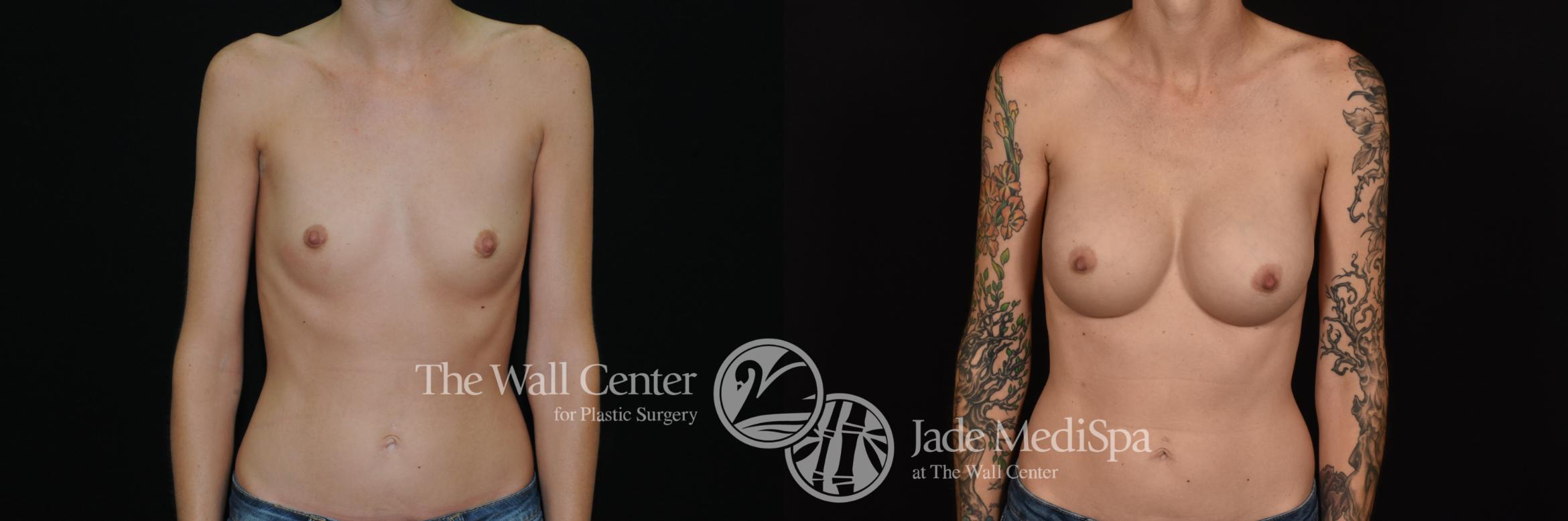 Before & After Breast Augmentation Case 1095 Front View in Shreveport, LA