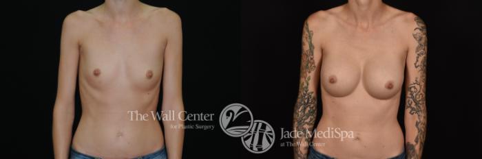 Before & After Breast Augmentation Case 1095 Front View in Shreveport, LA