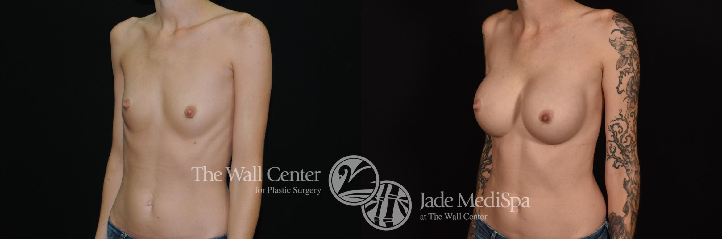 Before & After Breast Augmentation Case 1095 Left Oblique View in Shreveport, LA