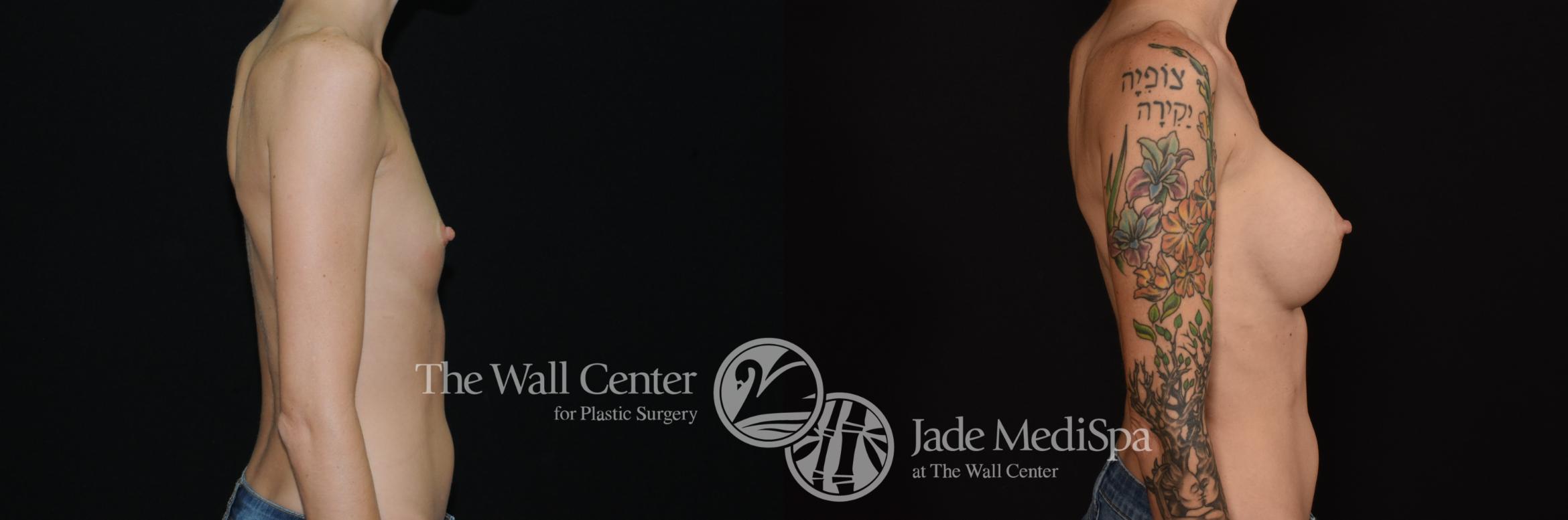 Before & After Breast Augmentation Case 1095 Right Side View in Shreveport, LA