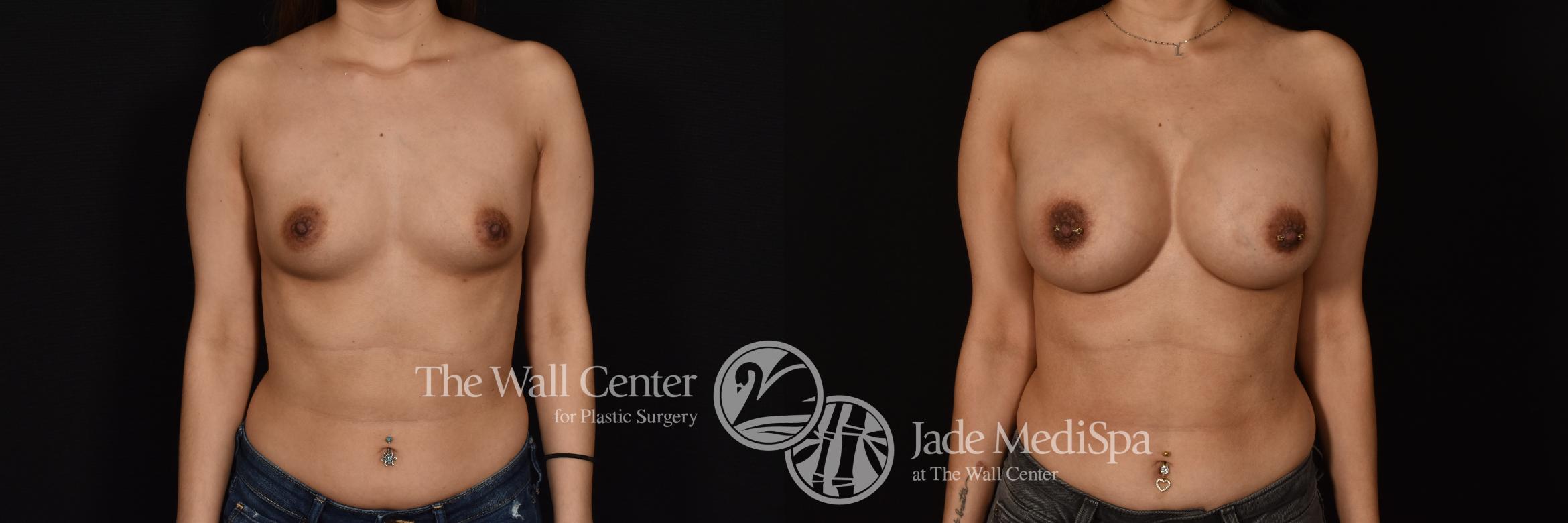 Before & After Breast Augmentation Case 1096 Front View in Shreveport, LA