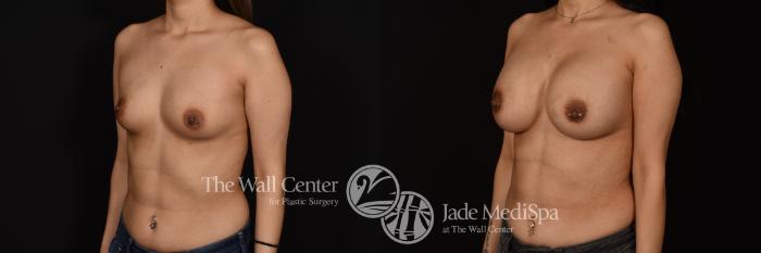 Before & After Breast Augmentation Case 1096 Left Oblique View in Shreveport, LA