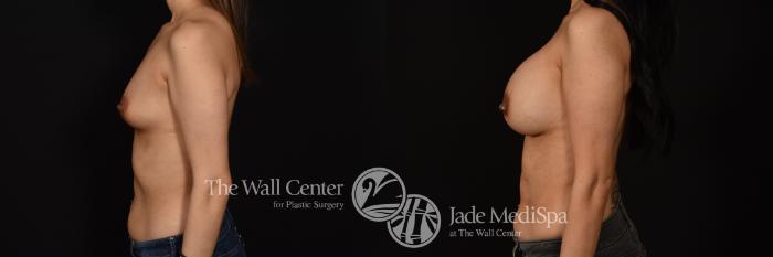 Before & After Breast Augmentation Case 1096 Left Side View in Shreveport, LA