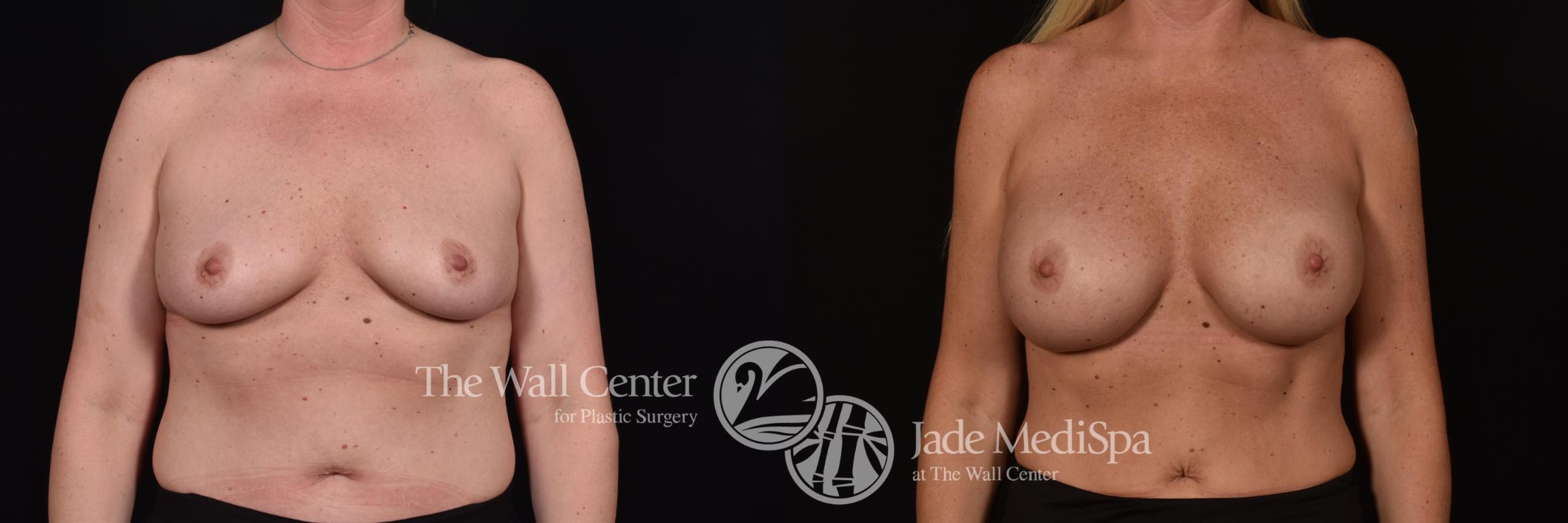 Before & After Breast Augmentation Case 1097 Front View in Shreveport, LA