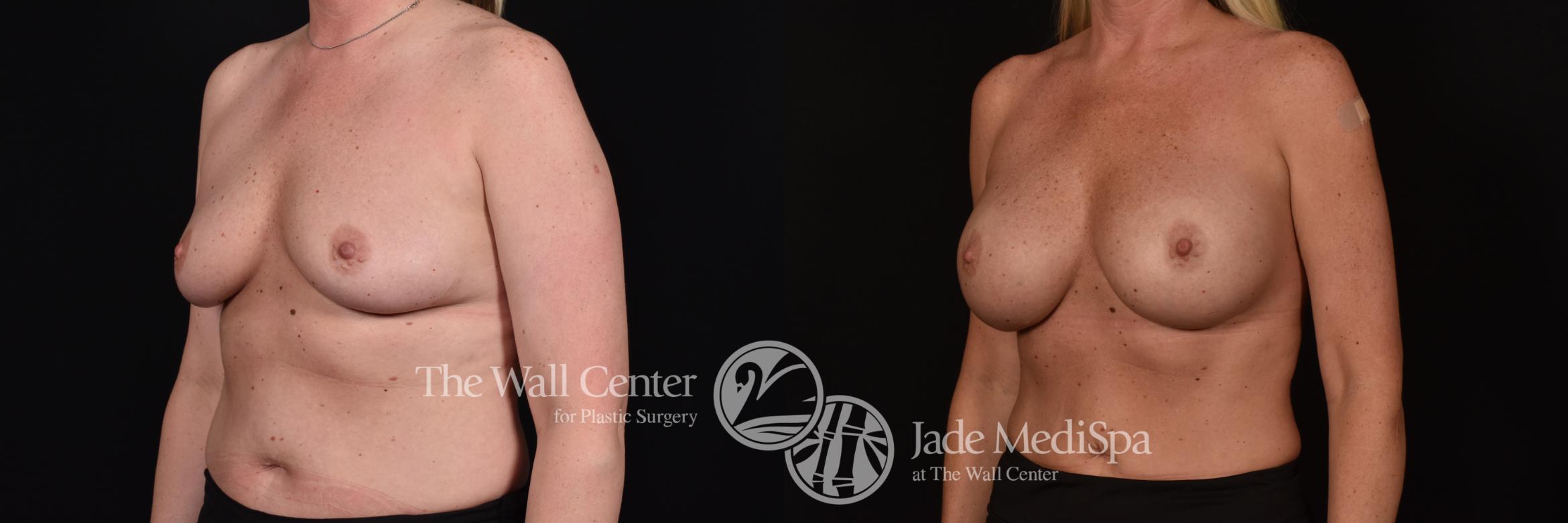 Before & After Breast Augmentation Case 1097 Left Oblique View in Shreveport, LA