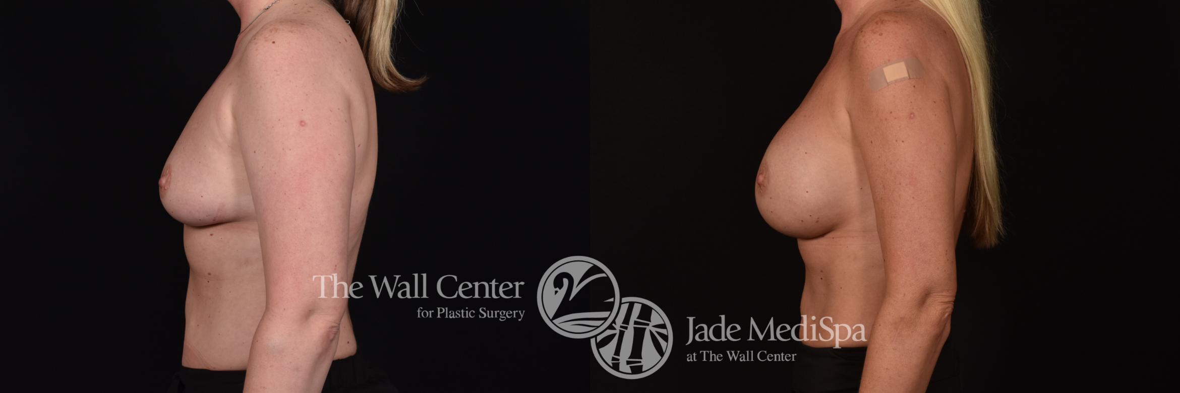 Before & After Breast Augmentation Case 1097 Left Side View in Shreveport, LA