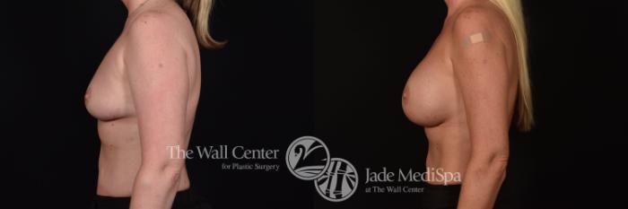 Before & After Breast Augmentation Case 1097 Left Side View in Shreveport, LA