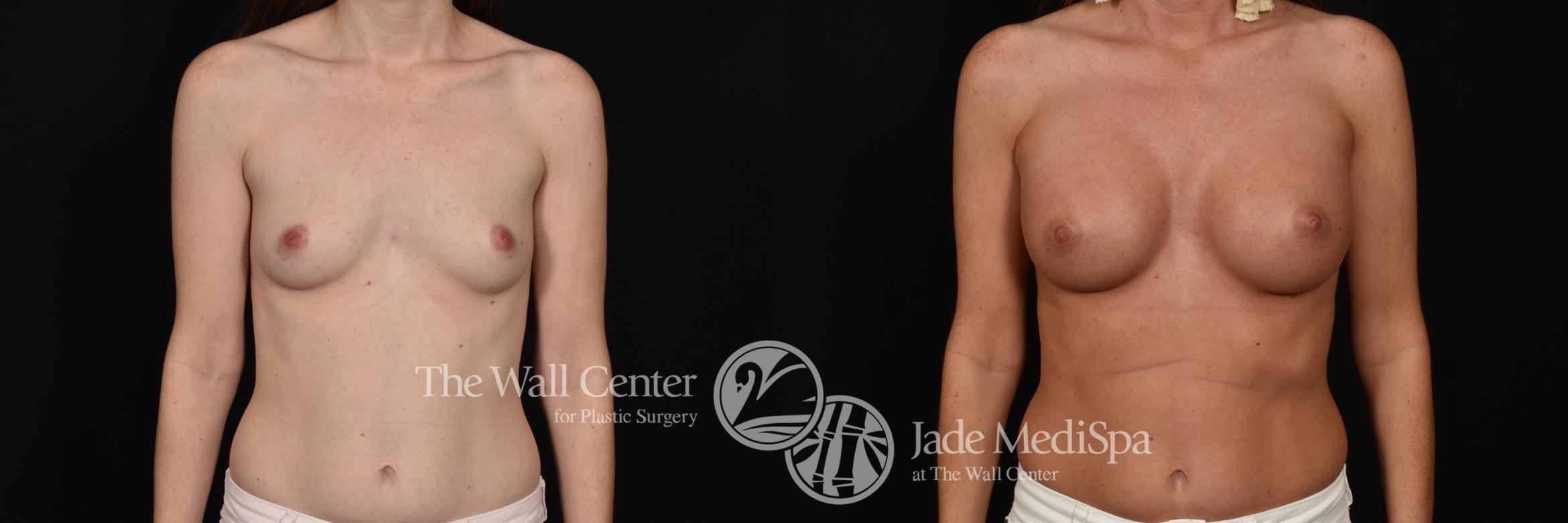 Before & After Breast Augmentation Case 1102 Front View in Shreveport, LA