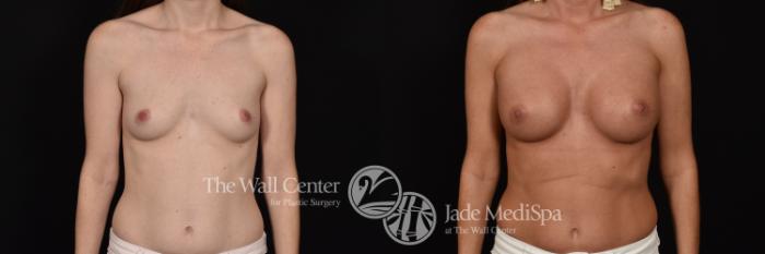 Before & After Breast Augmentation Case 1102 Front View in Shreveport, LA