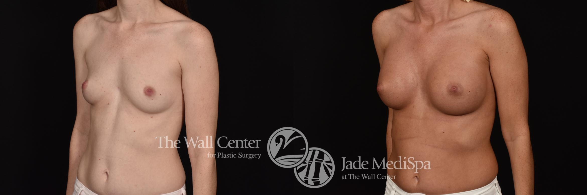Before & After Breast Augmentation Case 1102 Left Oblique View in Shreveport, LA
