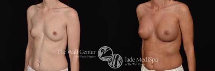 Before & After Breast Augmentation Case 1102 Left Oblique View in Shreveport, LA