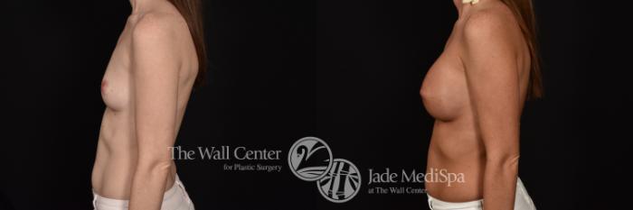 Before & After Breast Augmentation Case 1102 Left Side View in Shreveport, LA