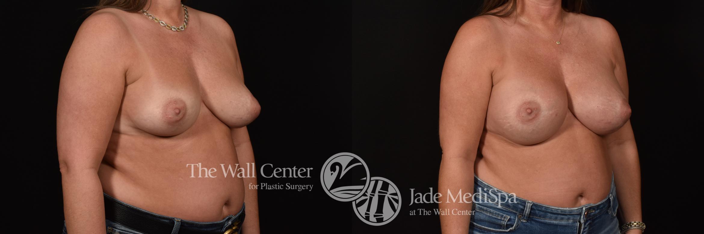 Before & After Breast Augmentation Case 1103 Right Oblique View in Shreveport, LA