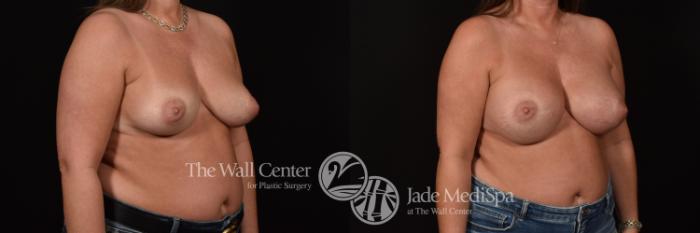 Before & After Breast Augmentation Case 1103 Right Oblique View in Shreveport, LA
