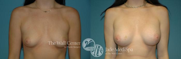 Before & After Breast Augmentation Case 1104 Front View in Shreveport, LA