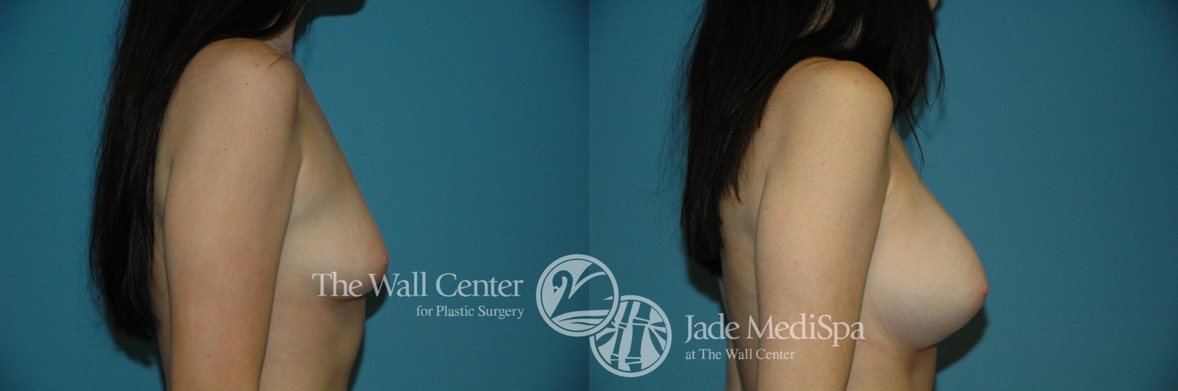 Before & After Breast Augmentation Case 1104 Right Side View in Shreveport, LA