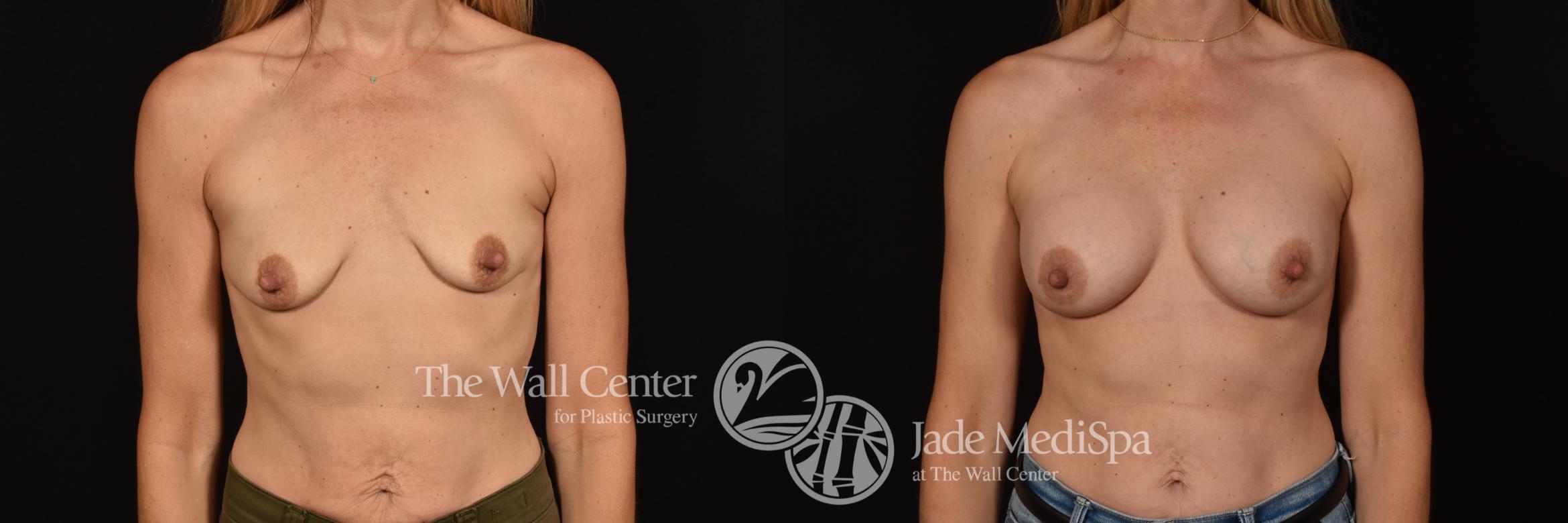 Before & After Breast Augmentation Case 1105 Front View in Shreveport, LA