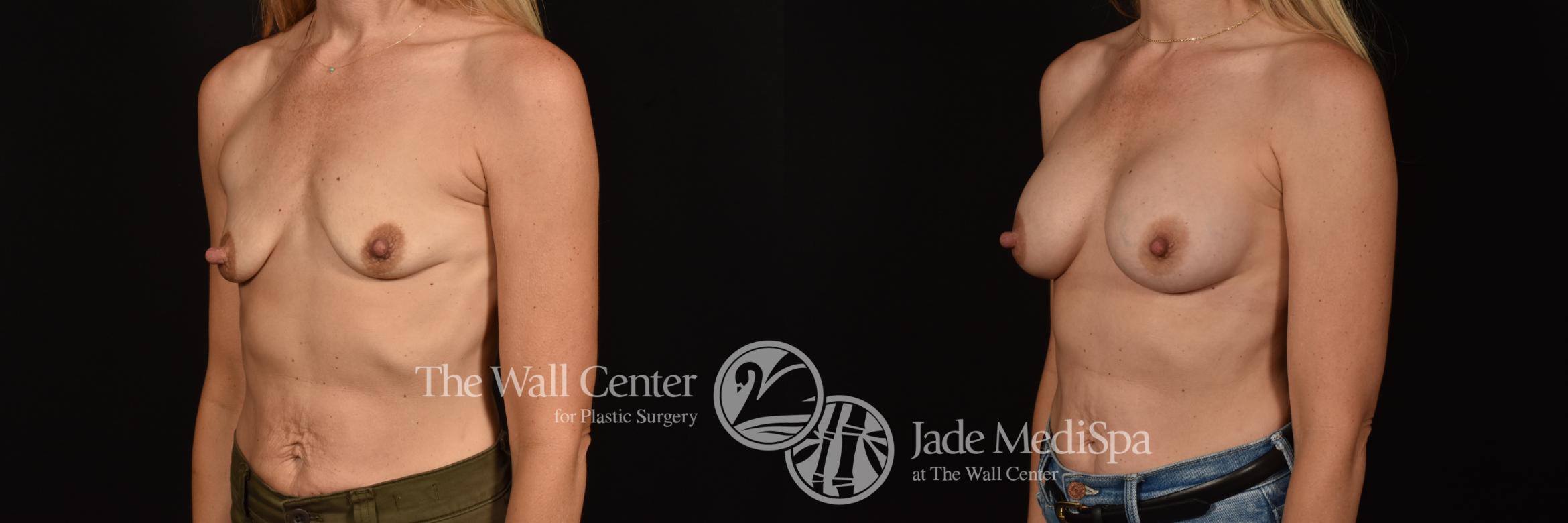 Before & After Breast Augmentation Case 1105 Left Oblique View in Shreveport, LA