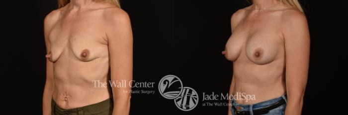 Before & After Breast Augmentation Case 1105 Left Oblique View in Shreveport, LA