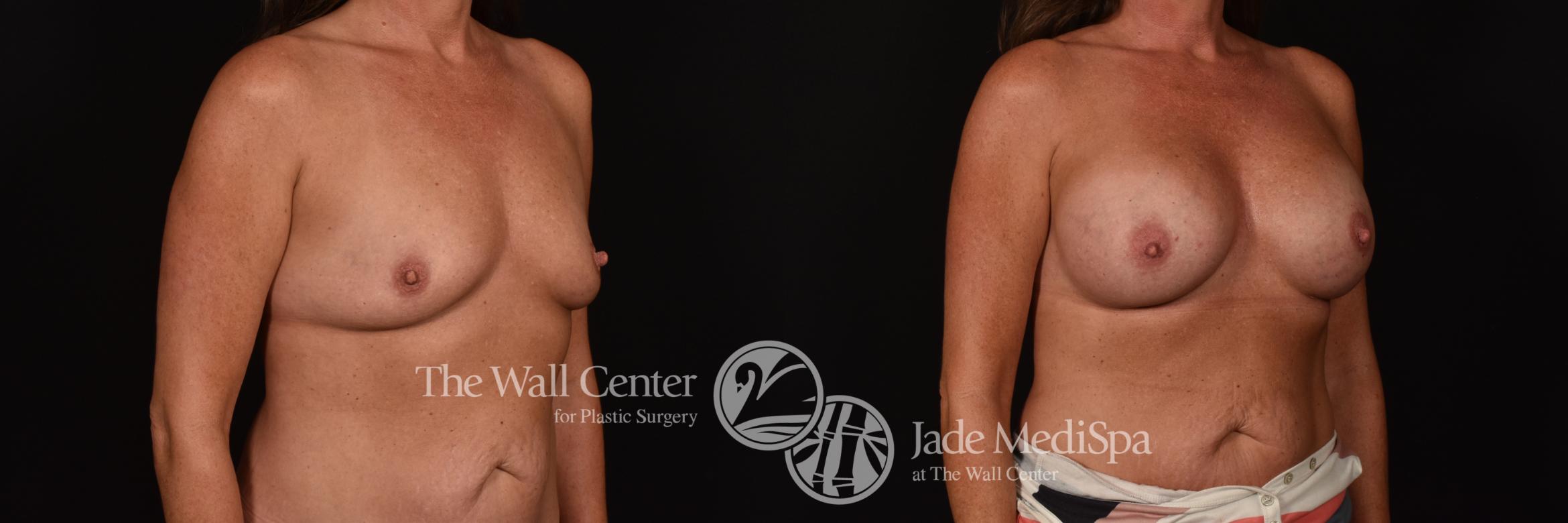 Before & After Breast Augmentation Case 1106 Right Oblique View in Shreveport, LA