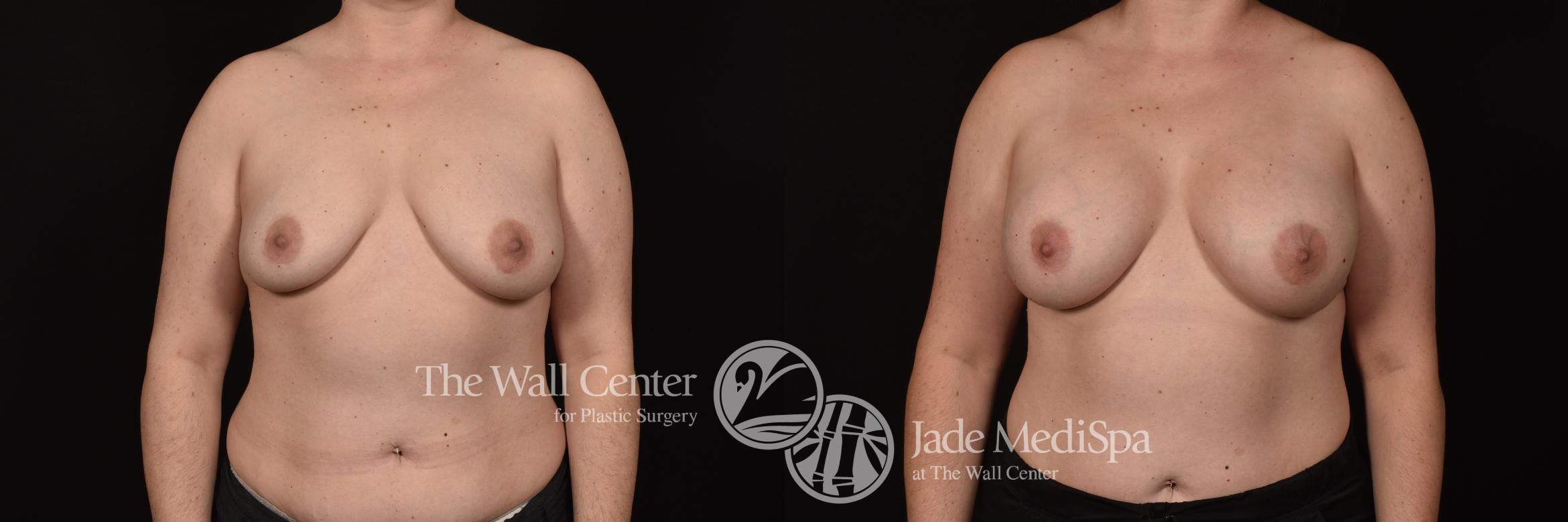 Before & After Breast Augmentation Case 1107 Front View in Shreveport, LA