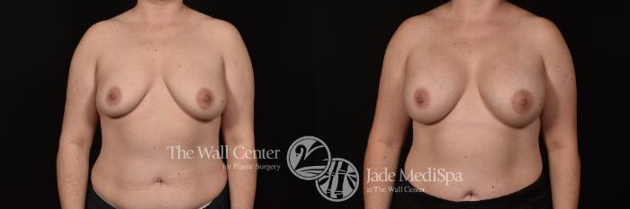 Before & After Breast Augmentation Case 1107 Front View in Shreveport, LA
