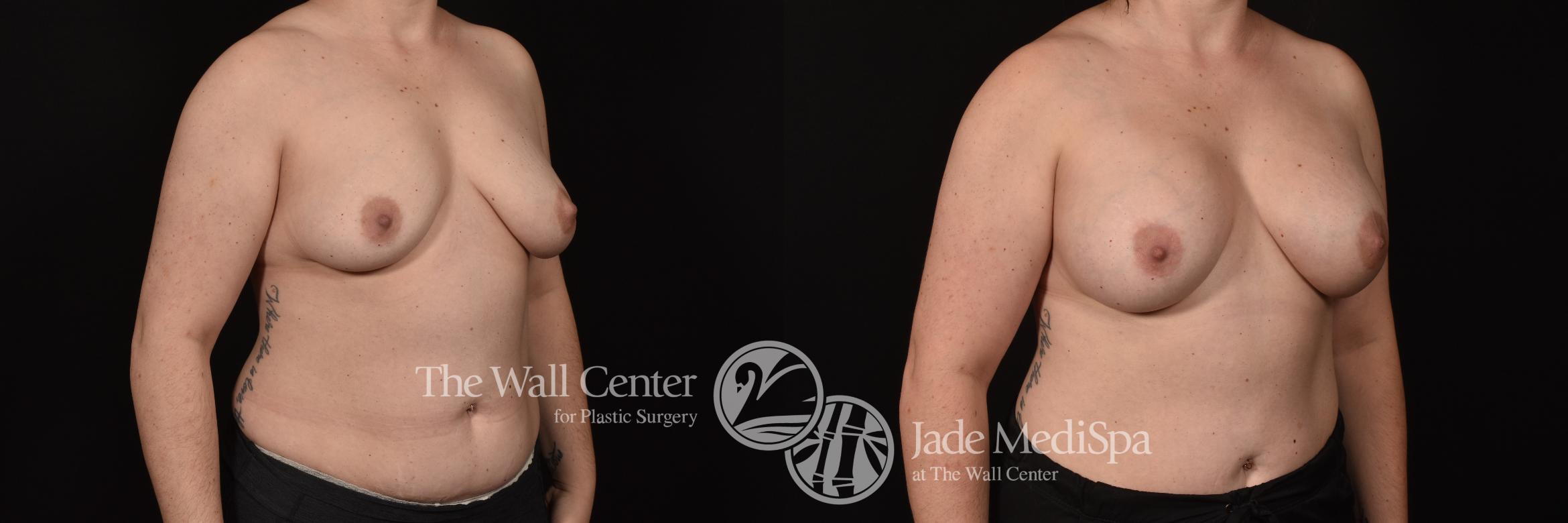 Before & After Breast Augmentation Case 1107 Right Oblique View in Shreveport, LA