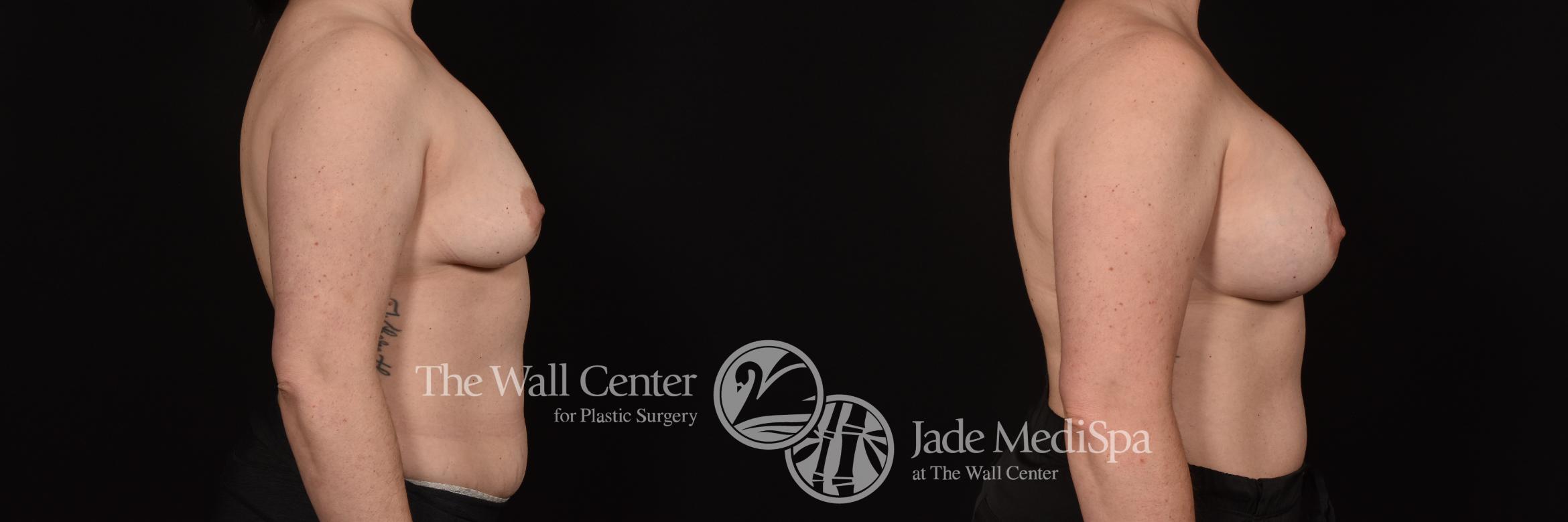 Before & After Breast Augmentation Case 1107 Right Side View in Shreveport, LA