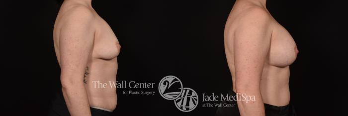 Before & After Breast Augmentation Case 1107 Right Side View in Shreveport, LA