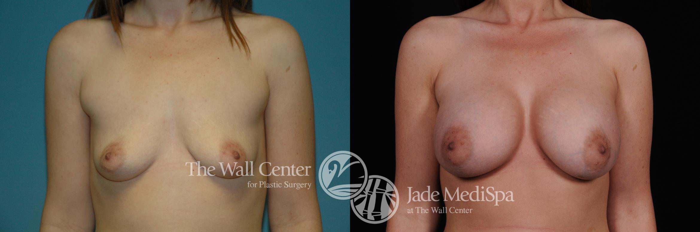 Before & After Breast Augmentation Case 1113 Front View in Shreveport, LA