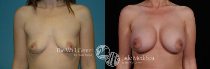 Before & After Breast Augmentation Case 1113 Front View in Shreveport, LA