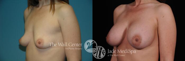 Before & After Breast Augmentation Case 1113 Left Oblique View in Shreveport, LA