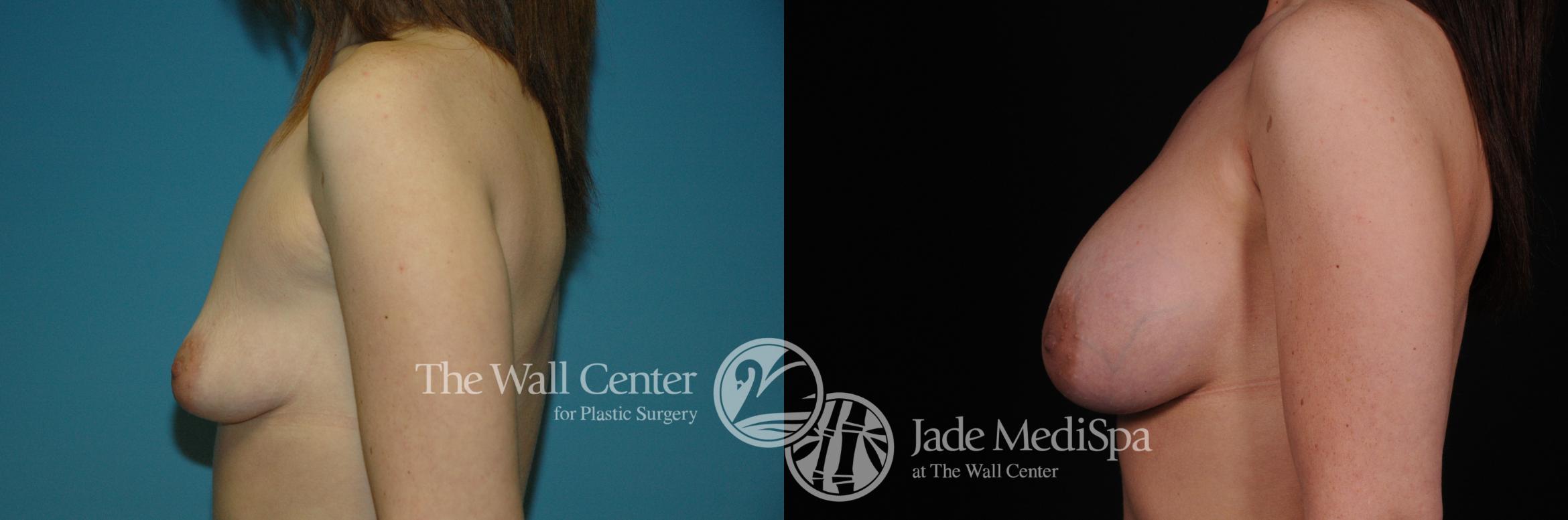 Before & After Breast Augmentation Case 1113 Left Side View in Shreveport, LA