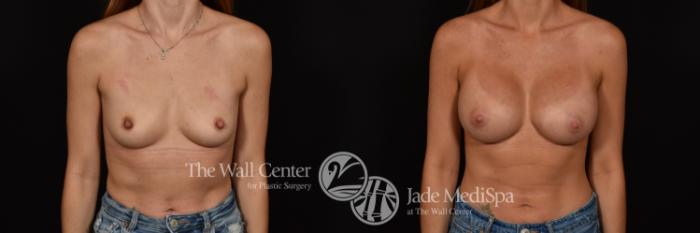 Before & After Breast Augmentation Case 1118 Front View in Shreveport, LA