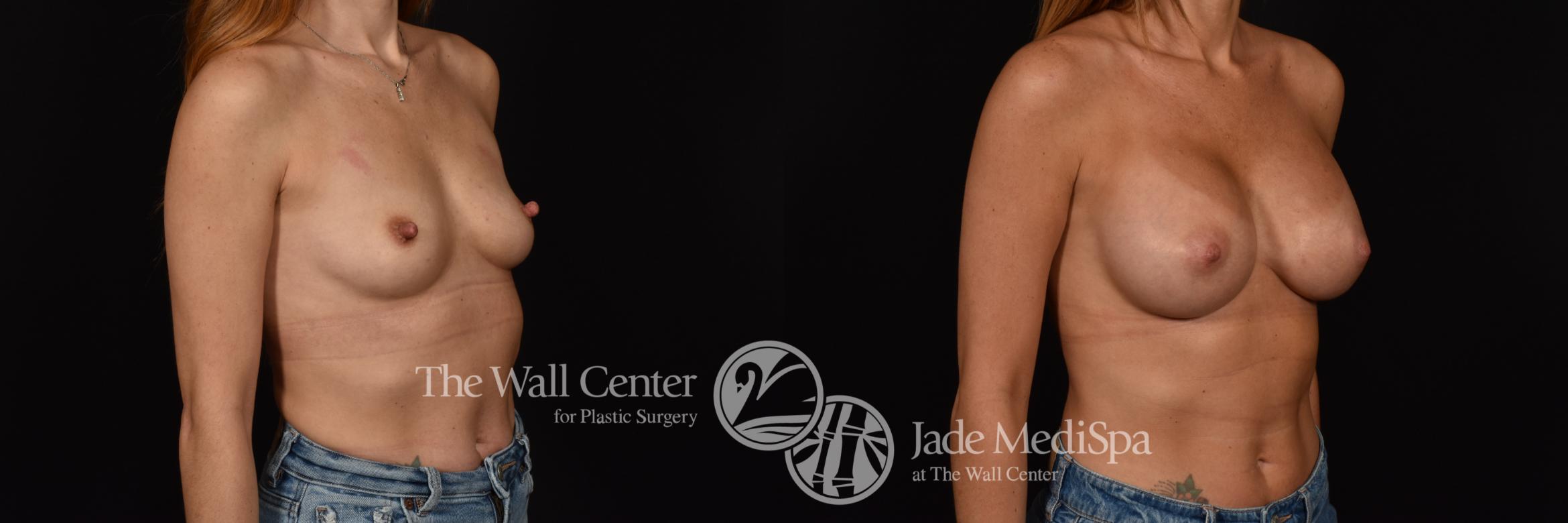 Before & After Breast Augmentation Case 1118 Right Oblique View in Shreveport, LA