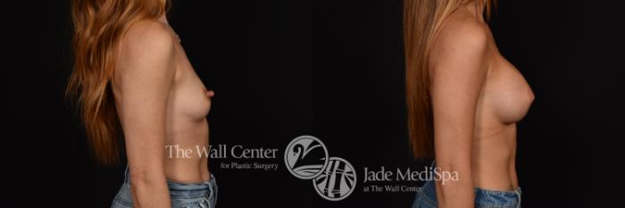 Before & After Breast Augmentation Case 1118 Right Side View in Shreveport, LA