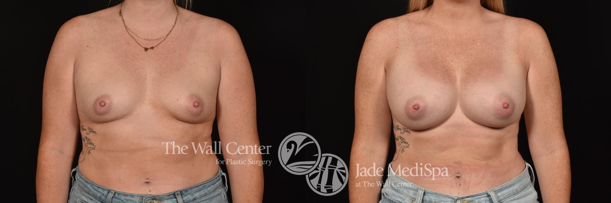 Before & After Breast Augmentation Case 1119 Front View in Shreveport, LA