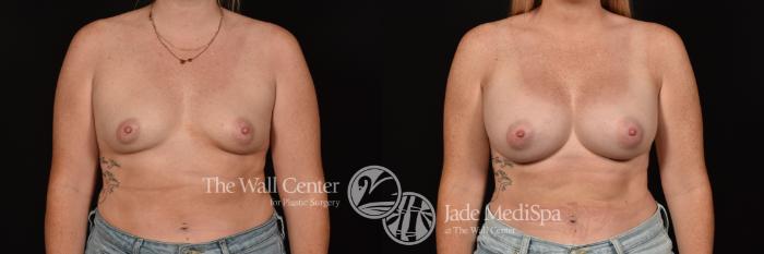 Before & After Breast Augmentation Case 1119 Front View in Shreveport, LA