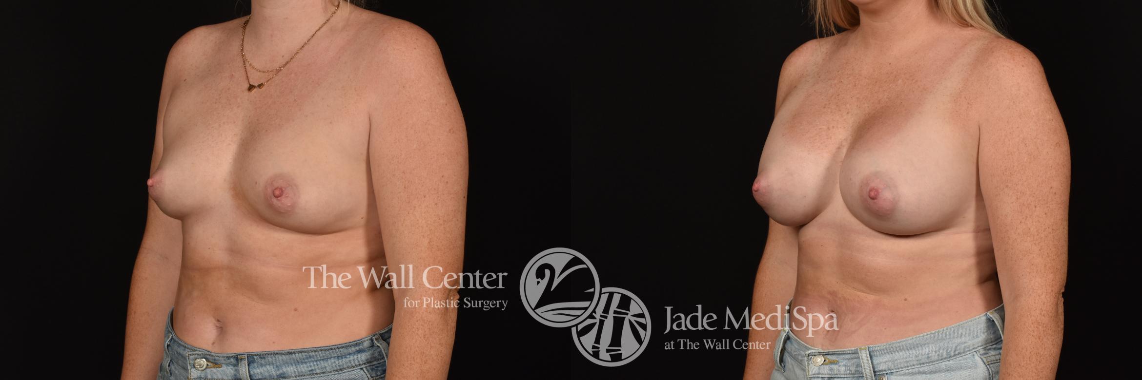 Before & After Breast Augmentation Case 1119 Left Oblique View in Shreveport, LA