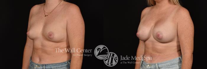 Before & After Breast Augmentation Case 1119 Left Oblique View in Shreveport, LA