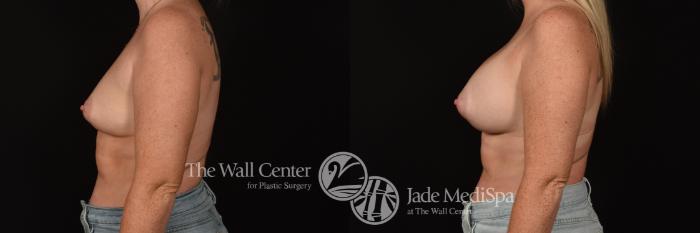 Before & After Breast Augmentation Case 1119 Left Side View in Shreveport, LA