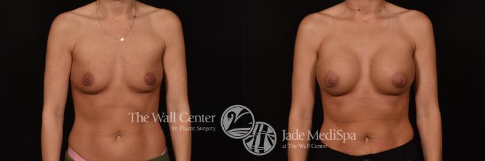 Before & After Breast Augmentation Case 1121 Front View in Shreveport, LA