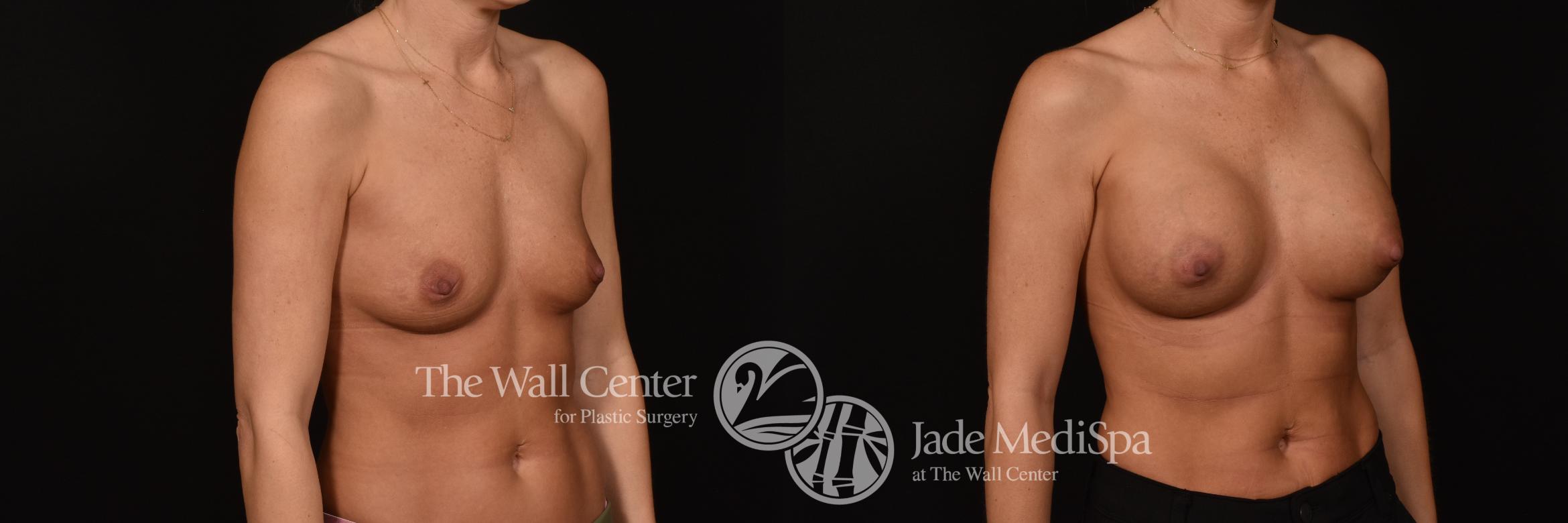 Before & After Breast Augmentation Case 1121 Right Oblique View in Shreveport, LA