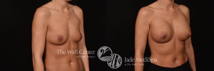 Before & After Breast Augmentation Case 1121 Right Oblique View in Shreveport, LA