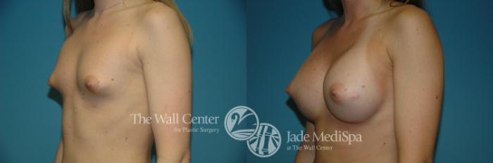 Before & After Breast Augmentation Case 1122 Left Oblique View in Shreveport, LA