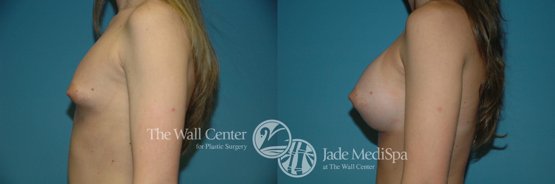 Before & After Breast Augmentation Case 1122 Left Side View in Shreveport, LA
