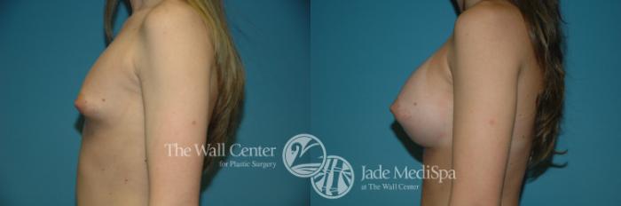 Before & After Breast Augmentation Case 1122 Left Side View in Shreveport, LA