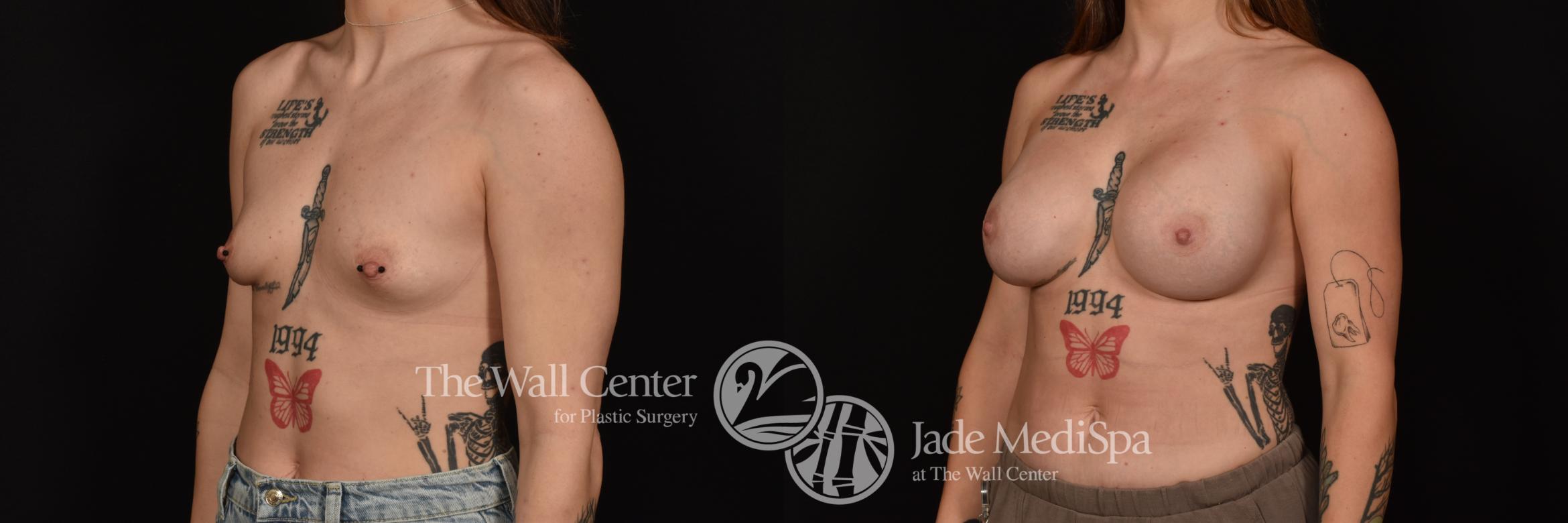Before & After Breast Augmentation Case 1124 Left Oblique View in Shreveport, LA