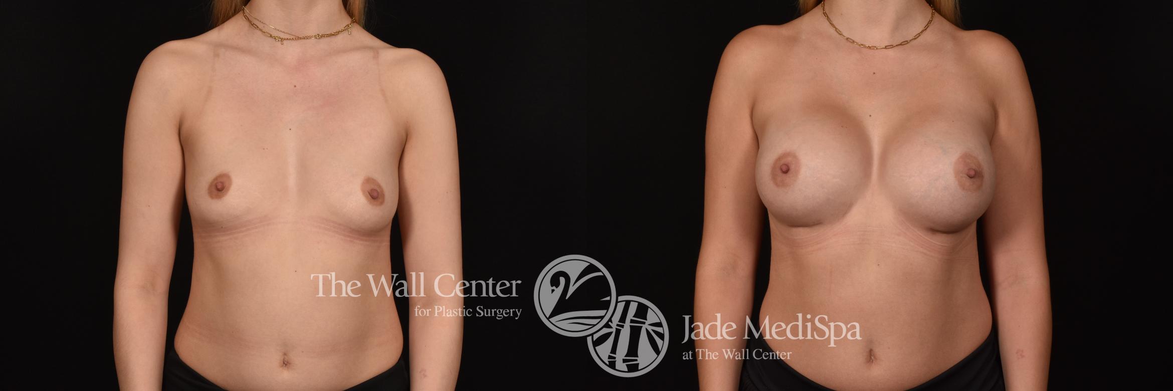 Before & After Breast Augmentation Case 1127 Front View in Shreveport, LA